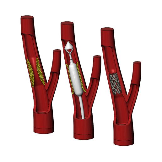 💊 3d printable Carotid artery stenting procedure diorama 3D